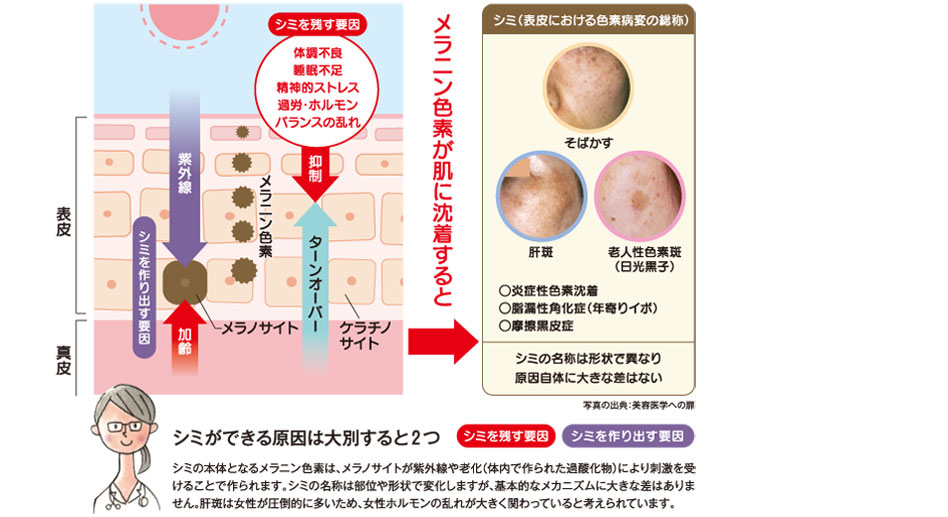 図・シミができる原因は大別すると２つ