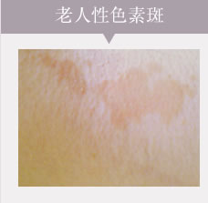老人性色素斑