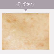 そばかす