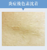 炎症後色素沈着