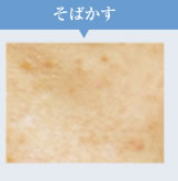 そばかす